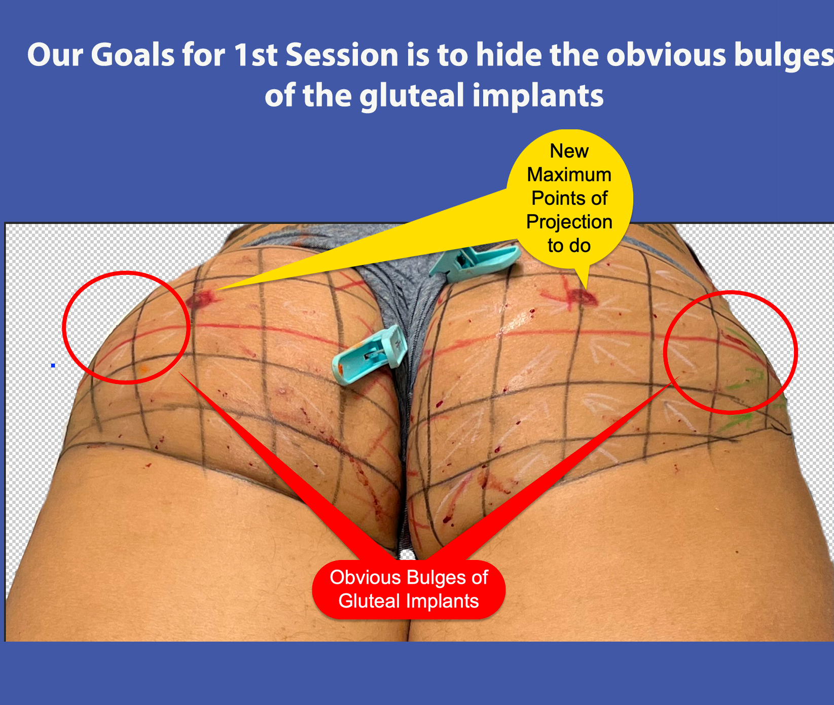 obvious bulges of gluteal implants