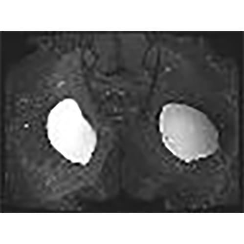 position-gluteal-implant-2