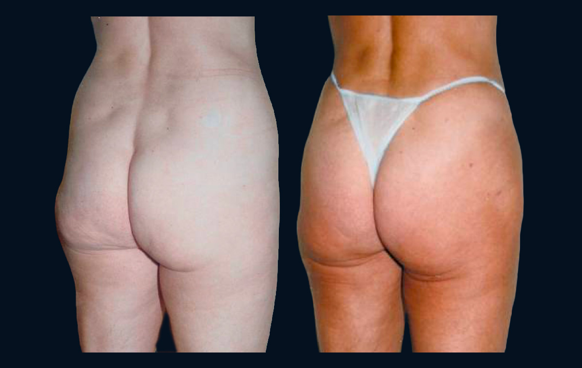 Female gluteal contour before and after lipoplasty showing the need for post-lipoplasty myomodulation