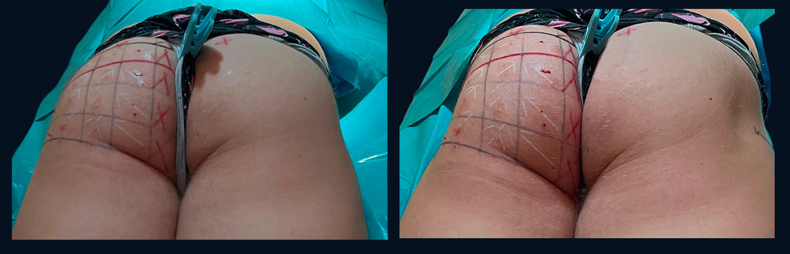 Male gluteal myomodulation showing relaxation and contraction
