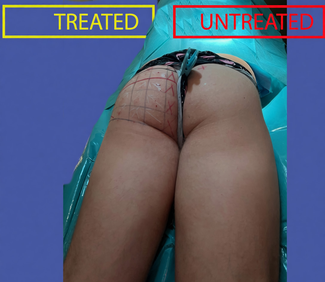 Treated and untreated non-athletic male gluteal contour at relaxation
