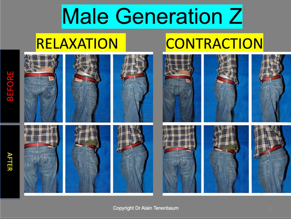 male-18years-gluteoplasty-endopeel