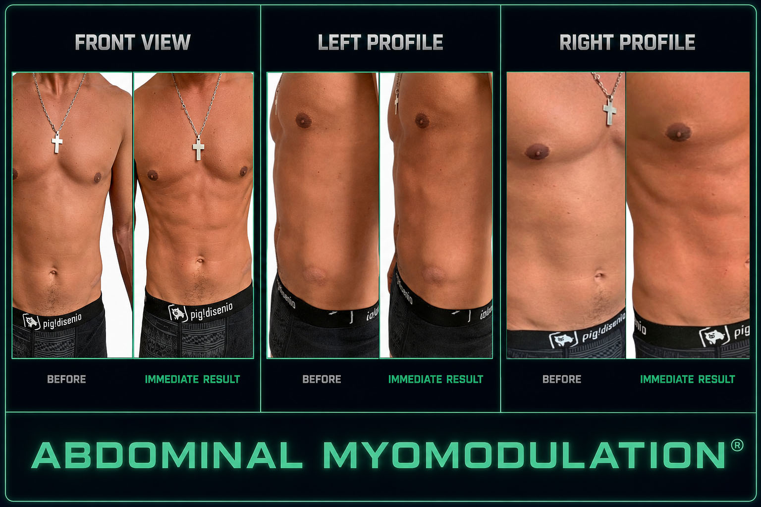 Abdominal myomodulation clinical results shown before and immediately after treatment in front, left-profile and right-profile views