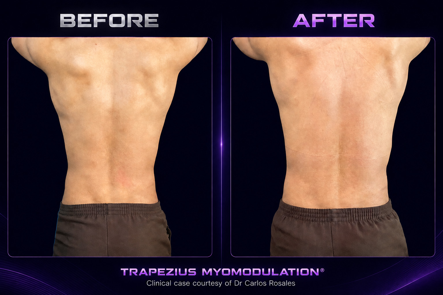 Trapezius myomodulation clinical result shown before and after treatment