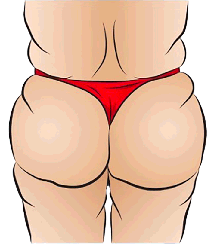 Gluteal width modification showing lateral enlargement and tightening