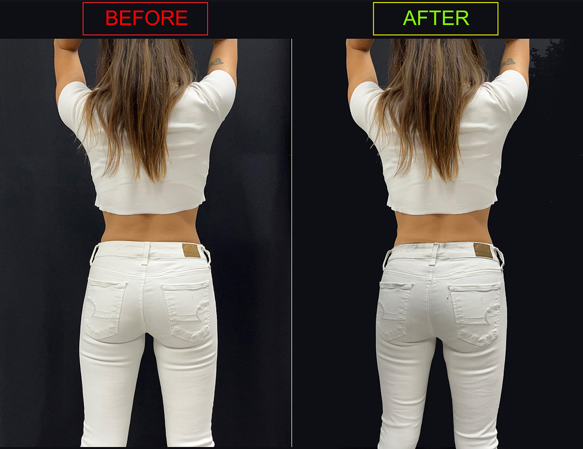 Before and after comparison of a Mexican female gluteal contour