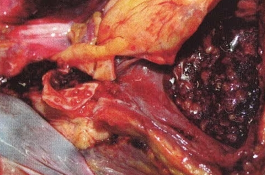 fat embolism 3 post gluteal lipoinjection
