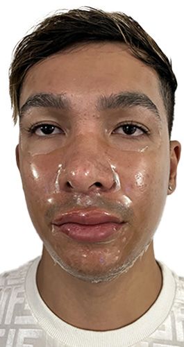 adrian-face-30min-peel-off