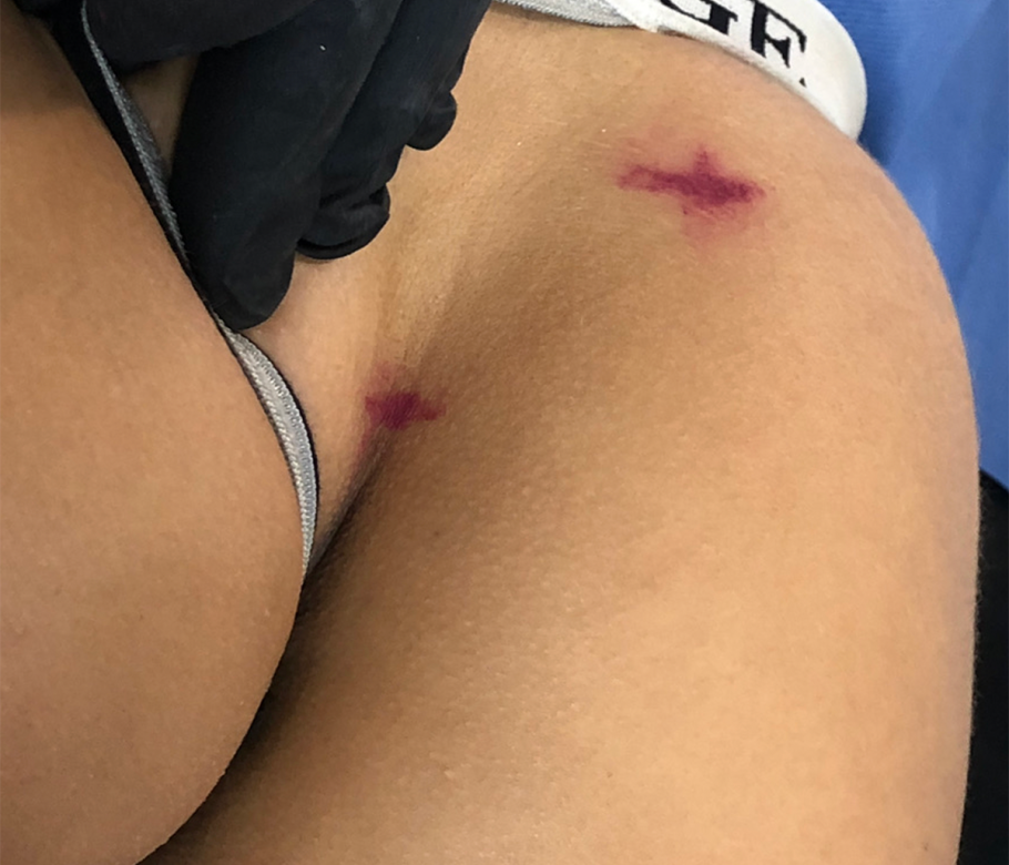 inspection of the inferior point of the pre sacral triangle