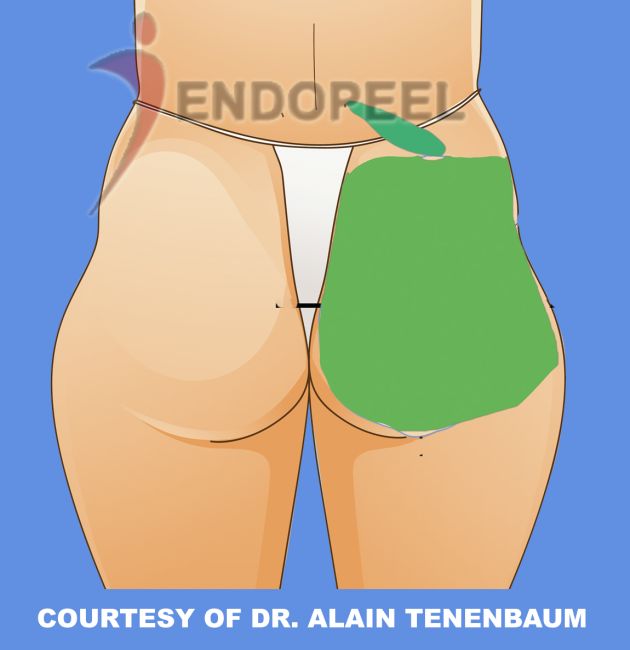 Lateral Depressions or Hip Dip