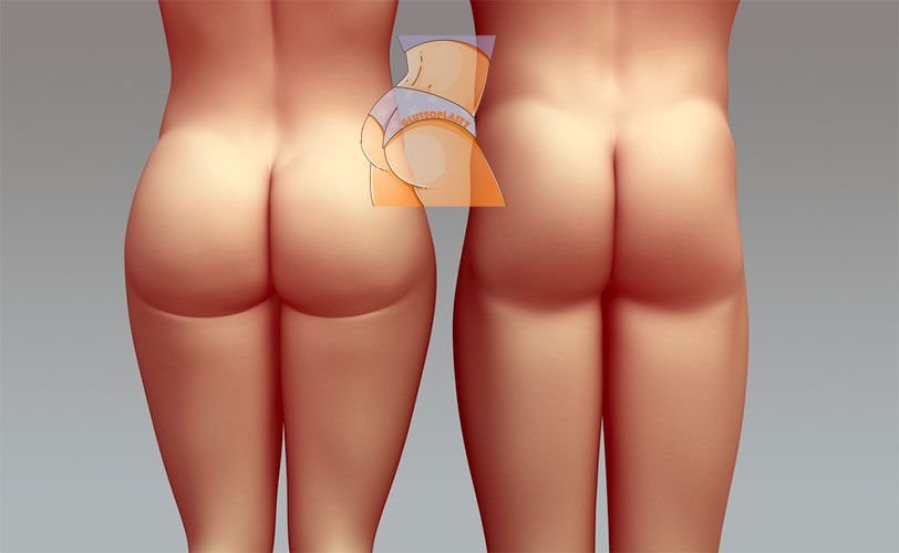 gluteoplasty home hero