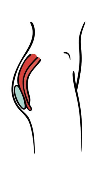 superficial-gluteal-implant