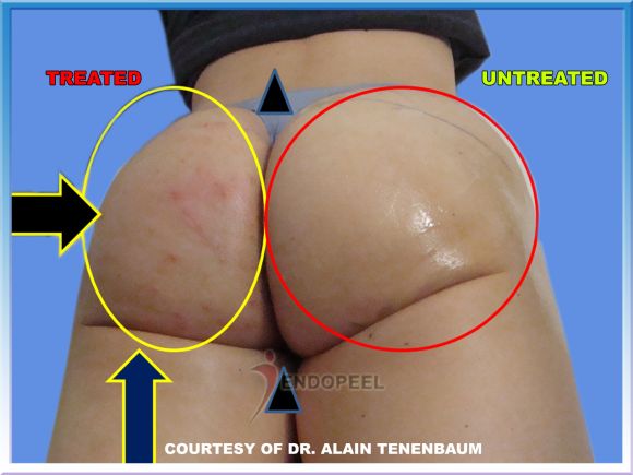 infra gluteal fold lifting