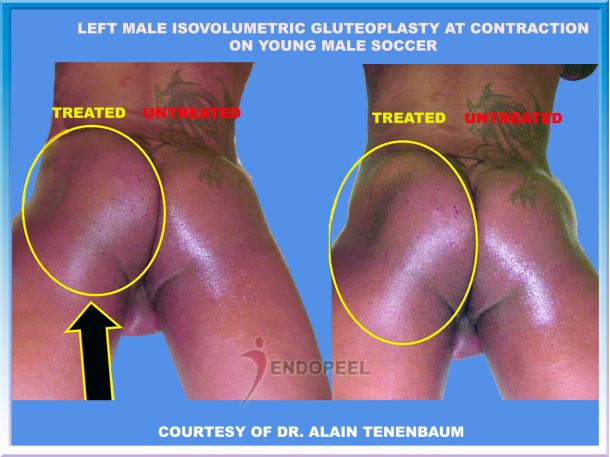 left male soccer gluteoplasty at contraction