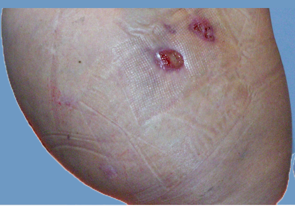 Gluteal Implant Extrusion