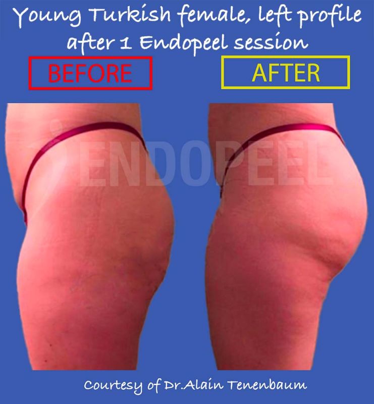 turkish-female-gluteoplasty-profile