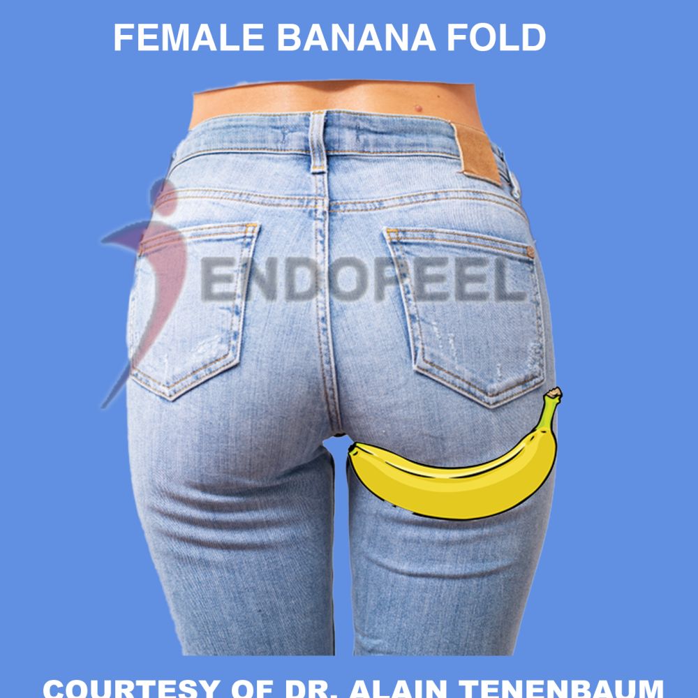 female banana fold