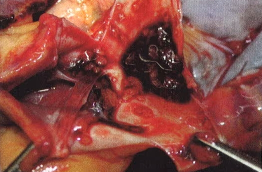fat embolism 2 post gluteal lipoinjection