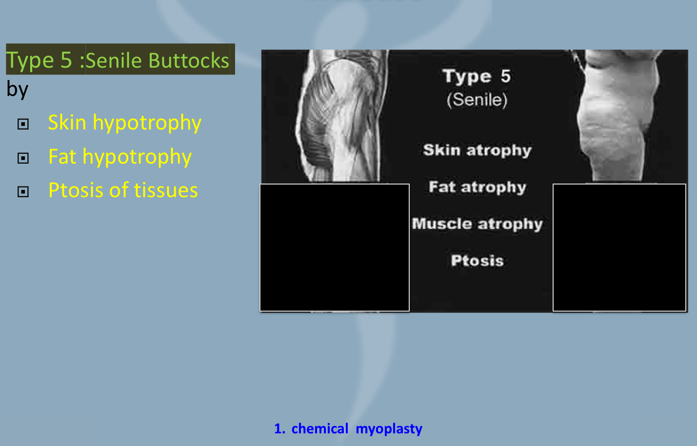 type 5 white female butts