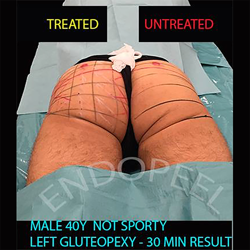 male post trauma gluteal atrophy