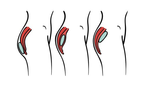 gluteal-implants