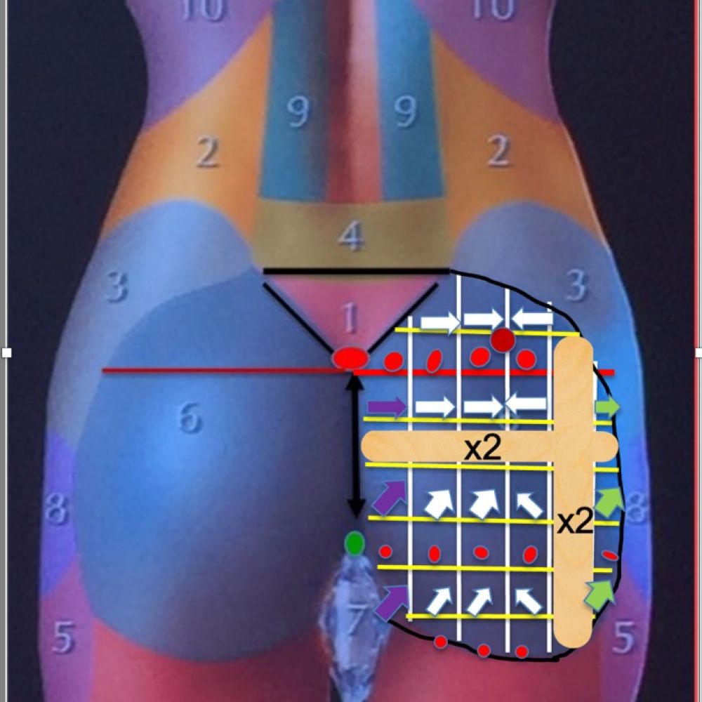 vectors-tensors-marking-gluteoplasty