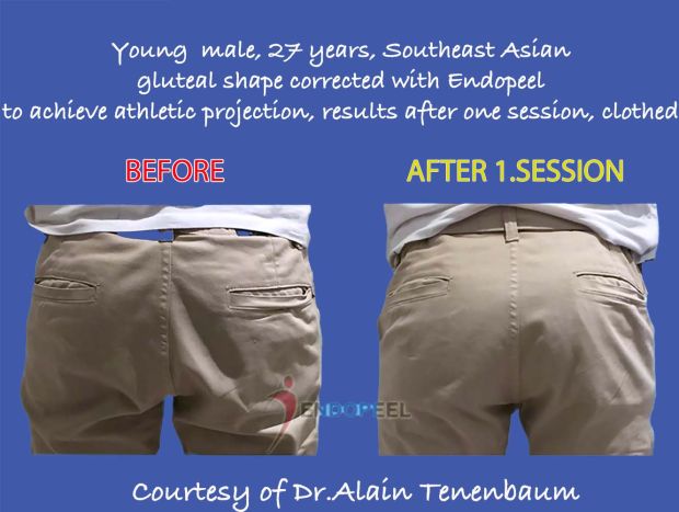 male-butt-projection